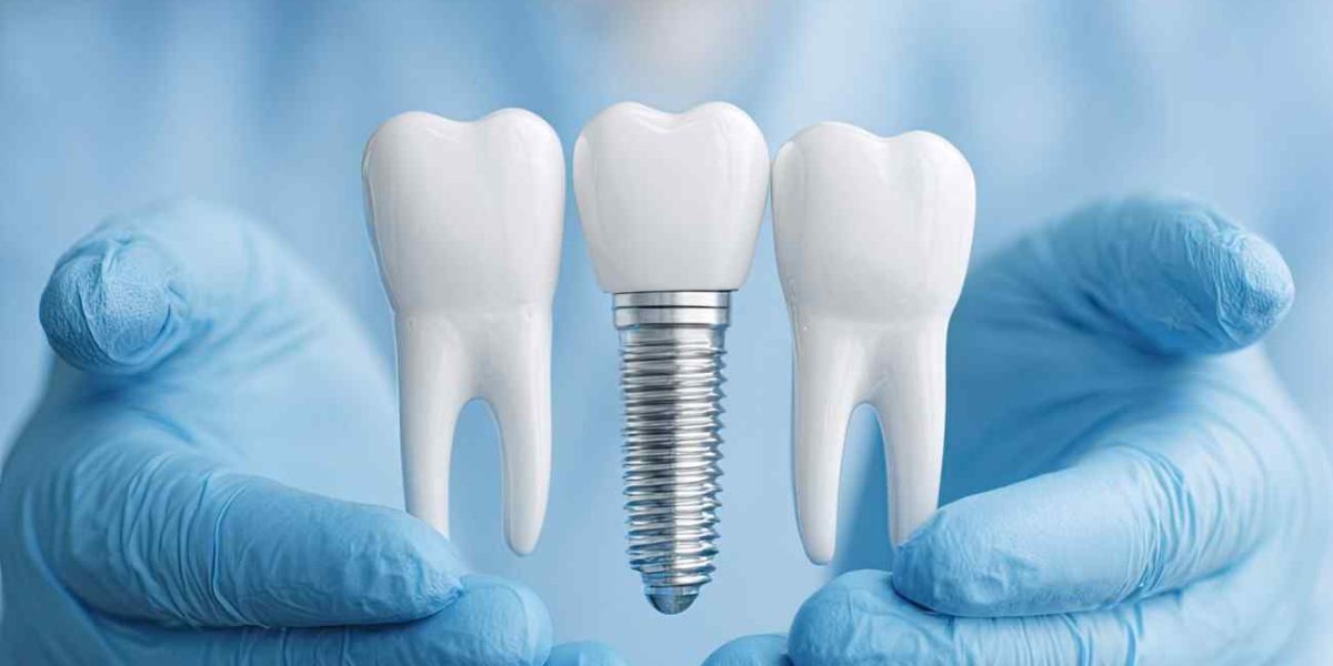 Dental Bridges vs Implants: What’s Better in San Jose